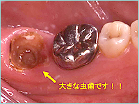 虫歯治療