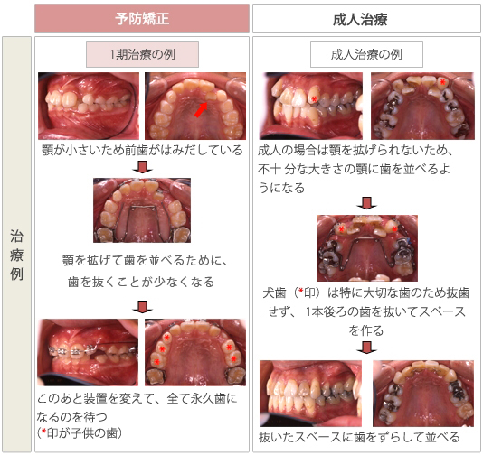 予防矯正と成人矯正の治療例